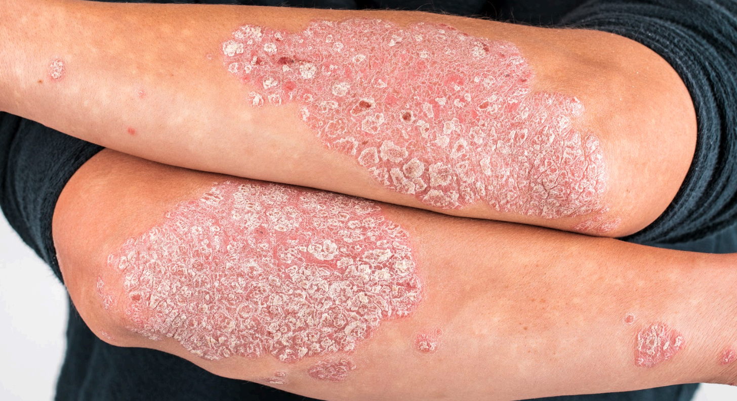 Psoriasis homeopathy treatment