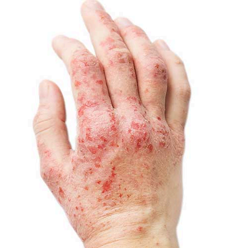 Eczema homeopathy treatment