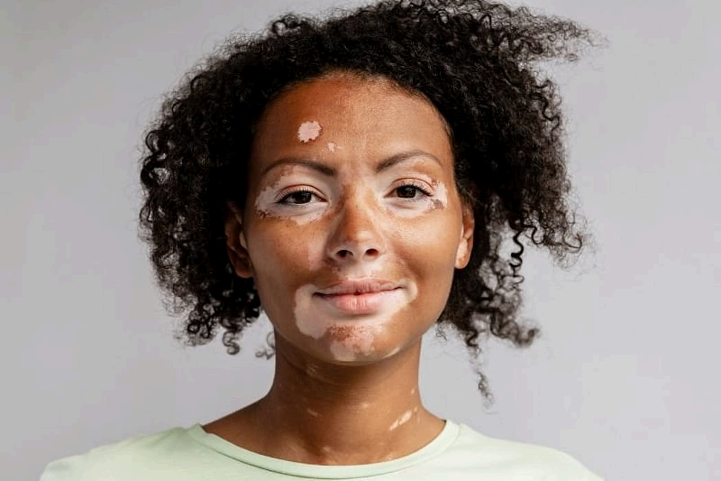 Vitiligo homeopathy treatment