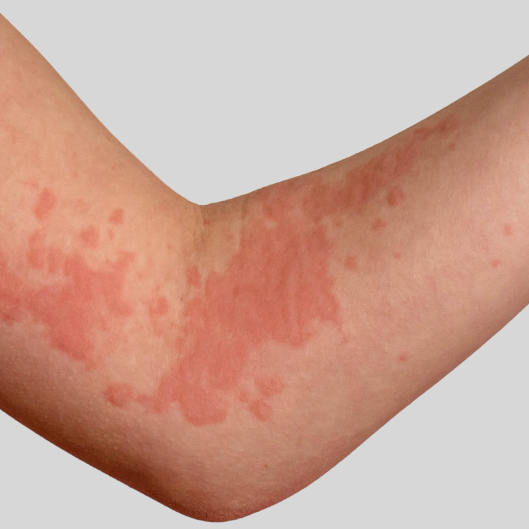 Urticaria homeopathy treatment