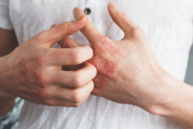 Lichen Planus homeopathy treatment