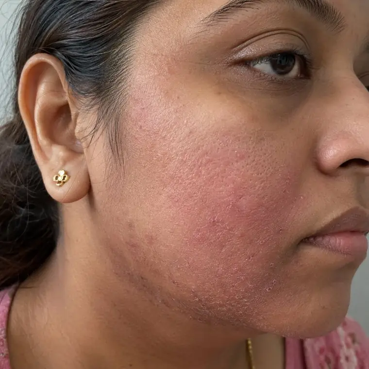 Acne before homeopathic treatment
