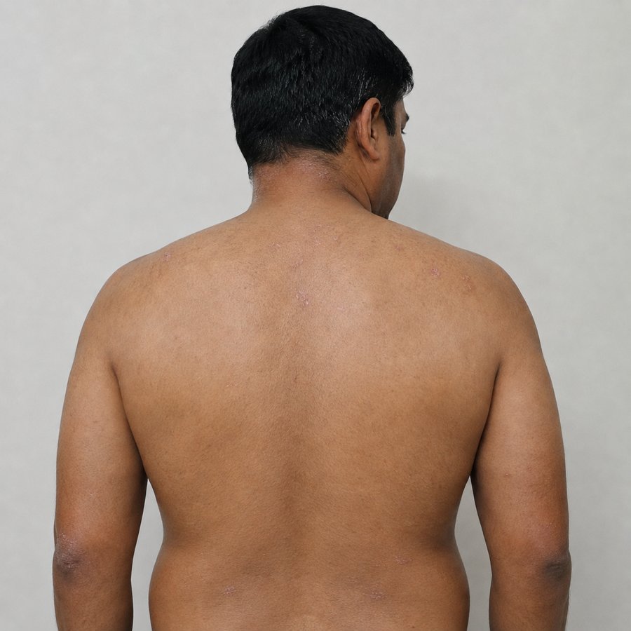 Psoriasis (Back) after homeopathic treatment