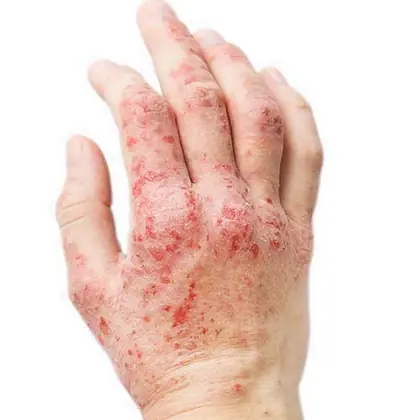 Eczema homeopathy treatment
