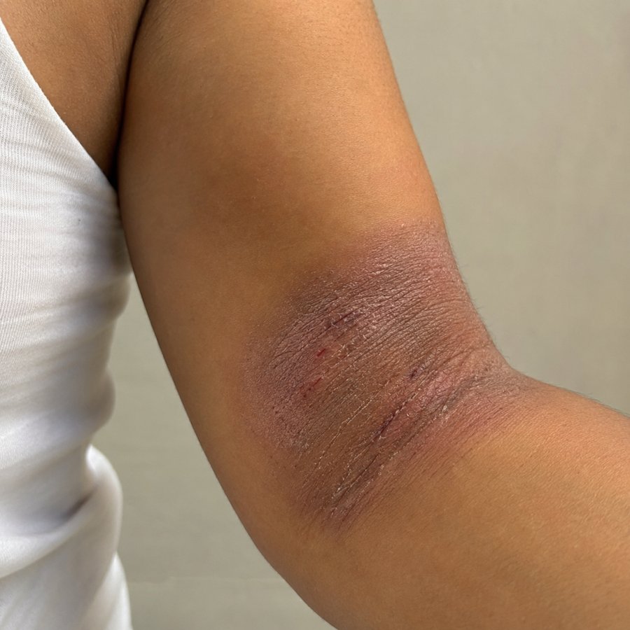 Eczema (Arm) before homeopathic treatment