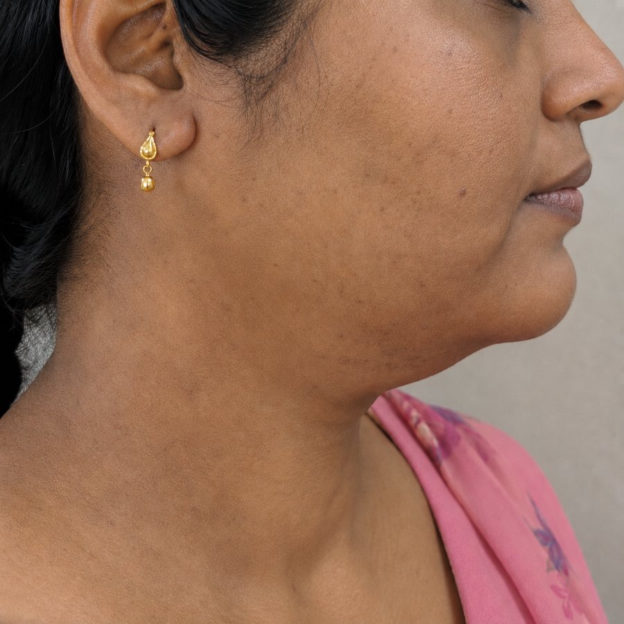 Lichen Planus Pigmentosus after homeopathic treatment