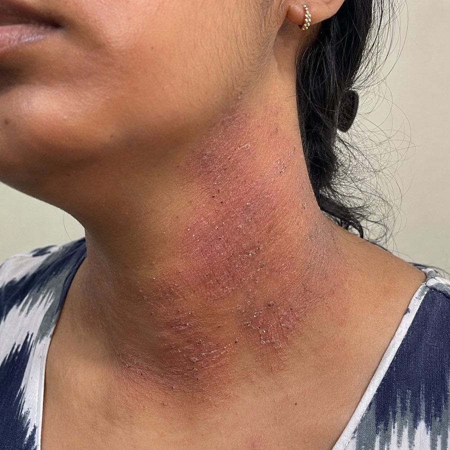 Neck Dermatitis before homeopathic treatment