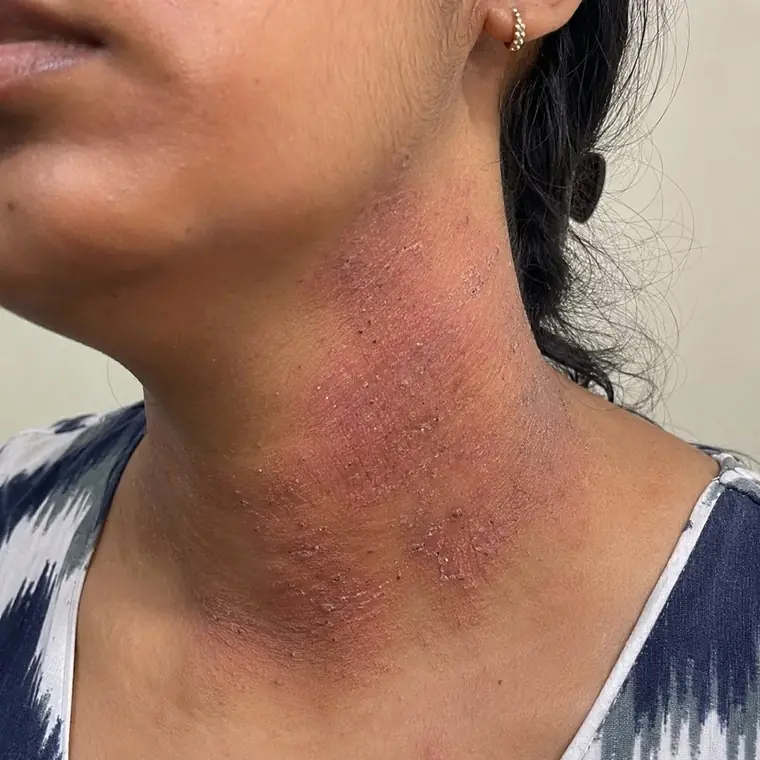 Neck Dermatitis before homeopathic treatment