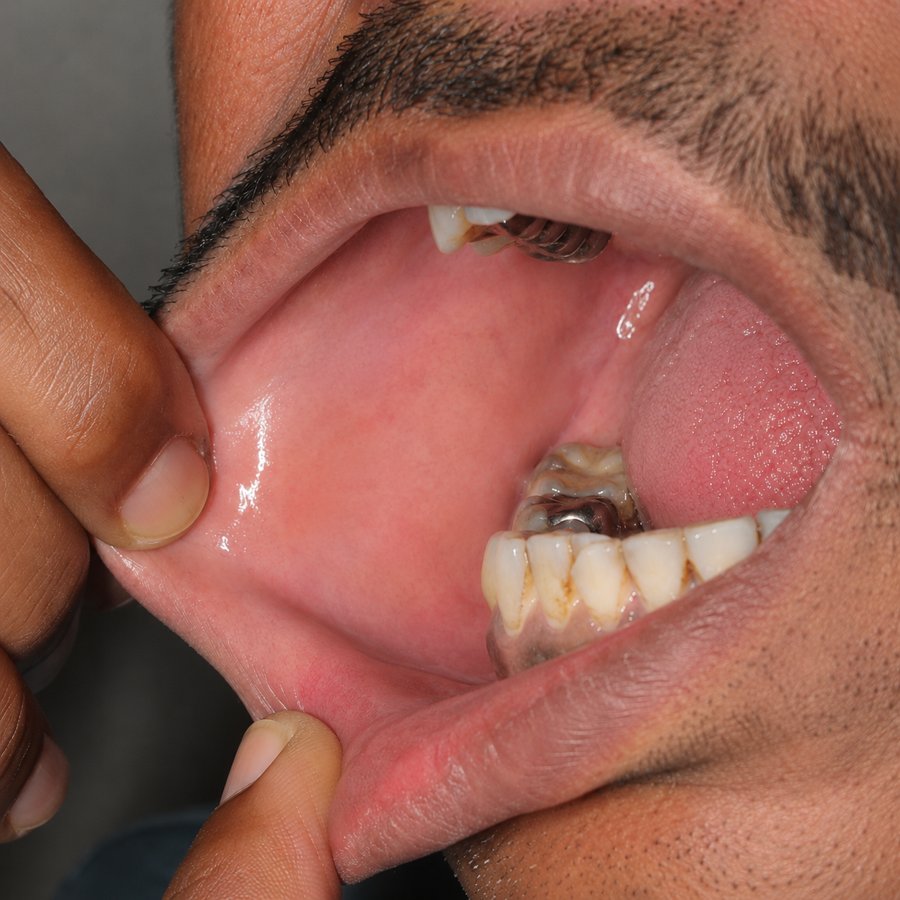 Oral Lichen Planus after homeopathic treatment