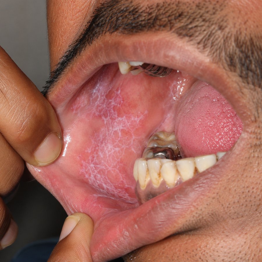 Oral Lichen Planus before homeopathic treatment