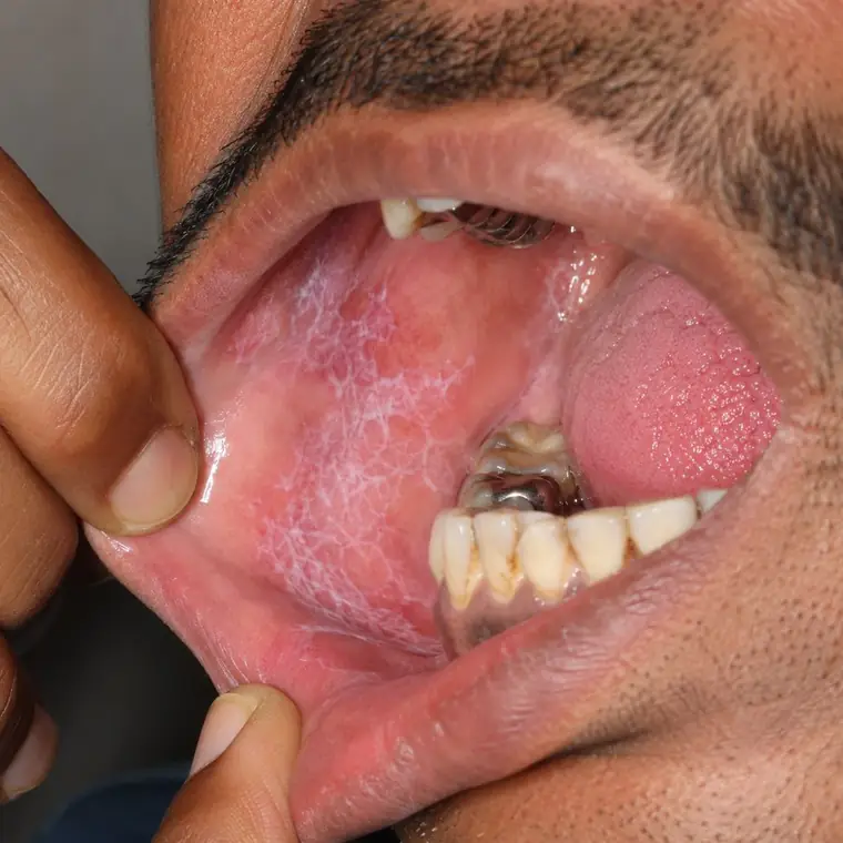 Oral Lichen Planus before homeopathic treatment