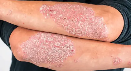 Psoriasis homeopathy treatment