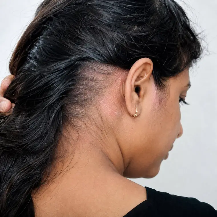 Scalp Psoriasis after homeopathic treatment